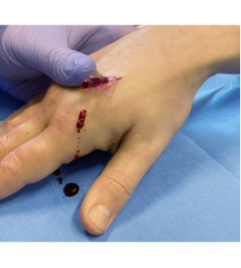 Model fotorealistickej cvičnej ruky Pete na nácvik punkcie