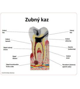 Model - Zubný kaz, 10-násobné zväčšenie