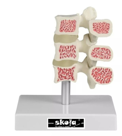 Model osteoporózy – 3 stavce v&nbsp;reze