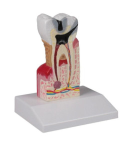 Model - Zubný kaz, 10-násobné zväčšenie