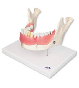Model - Zubné ochorenia