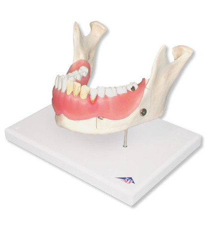 Model - Zubné ochorenia