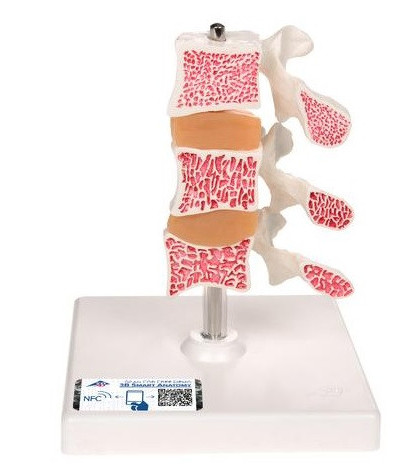 Model osteoporózy – 3 stavce v reze
